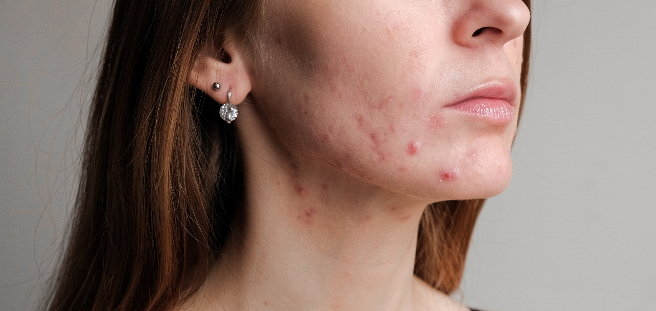 Dra Gladys Mattei - Acne