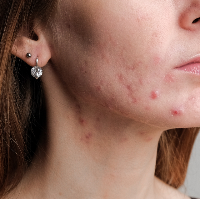 Dra Gladys Mattei - Acne