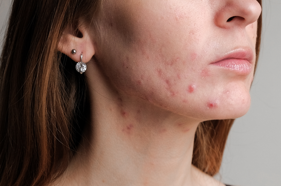 Dra Gladys Mattei - Acne